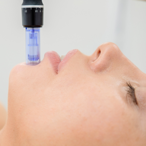 microneedling