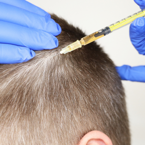 haartransplantatie (300 x 300 px)