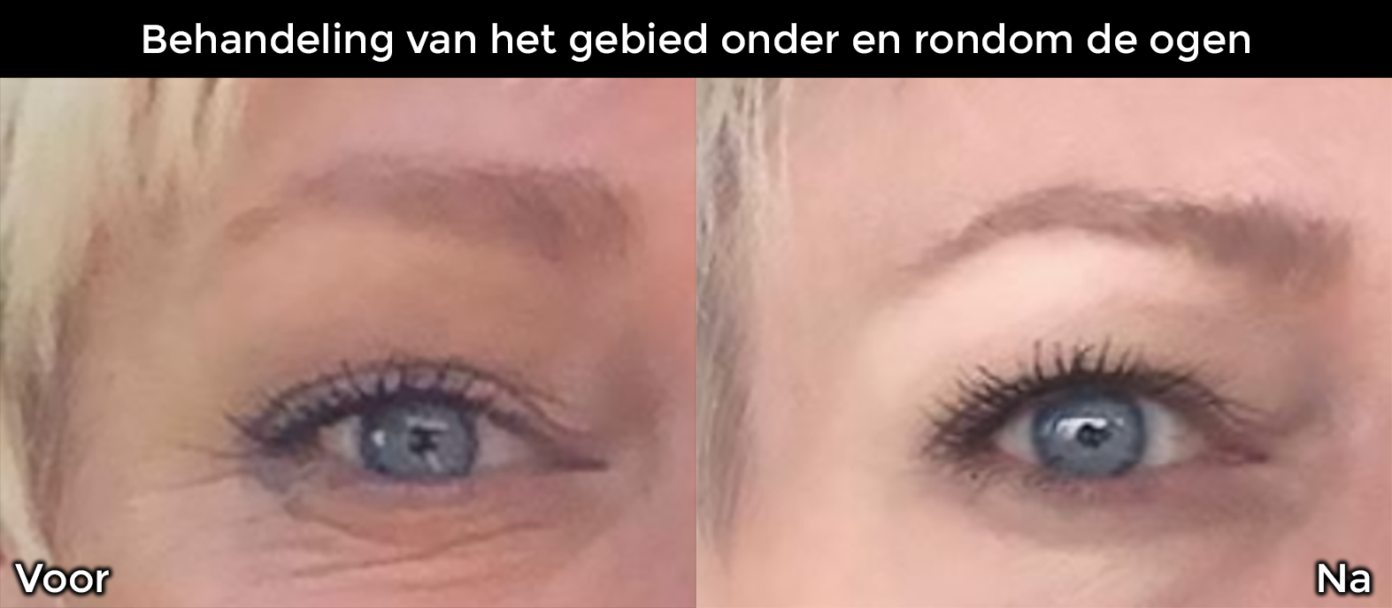 Behandeling van het gebied onder en rondom de ogen