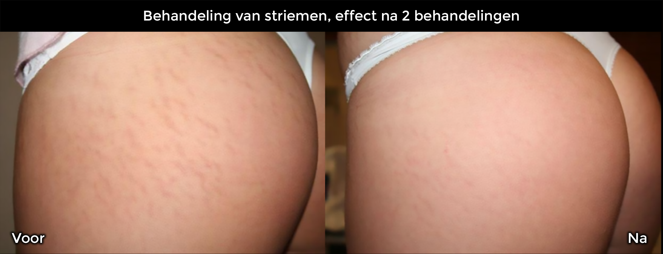 Behandeling van striemen, effect na 2 behandelingen