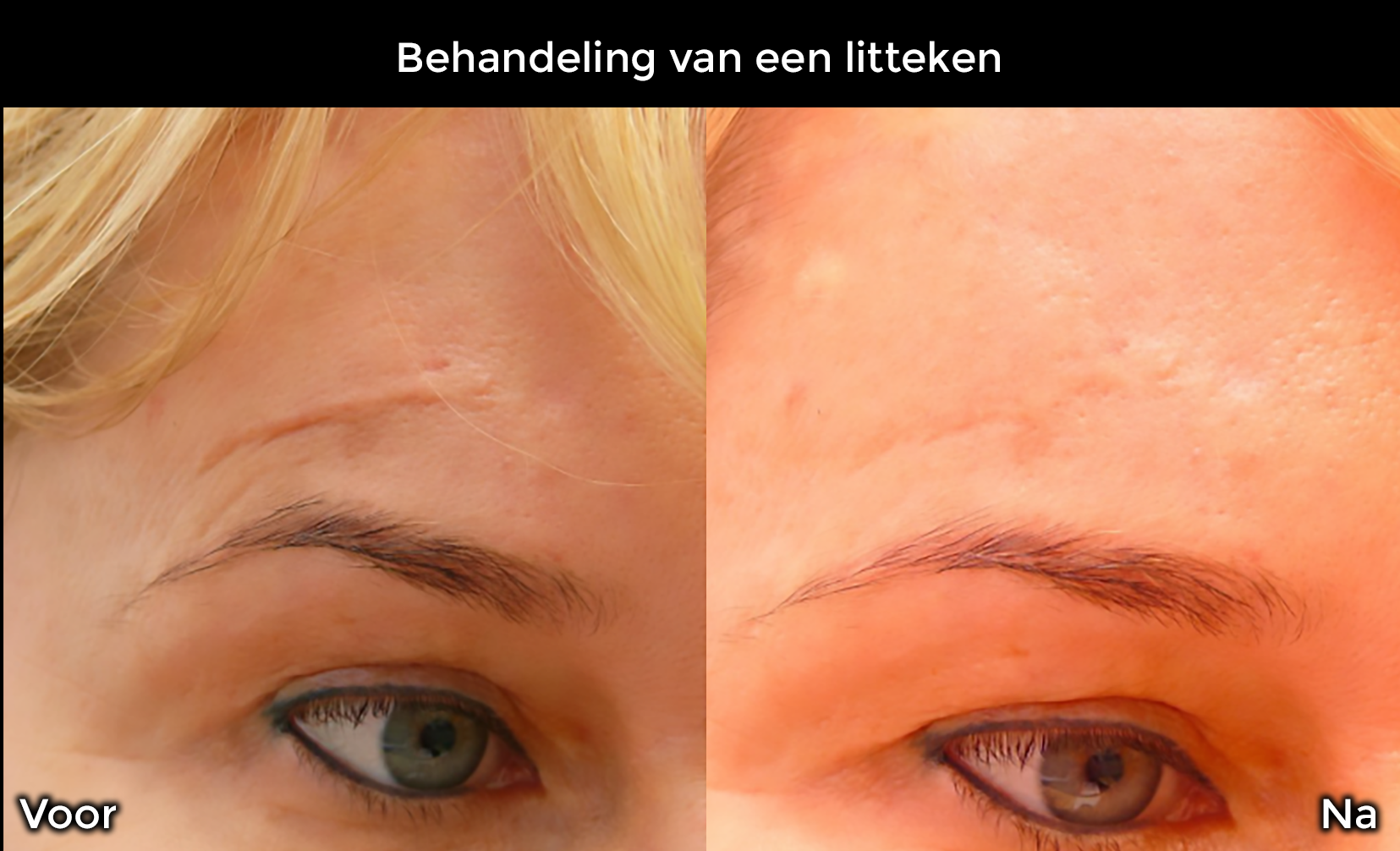 Behandeling van een litteken