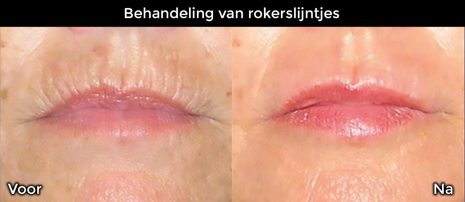 Behandeling van rokerslijntjes